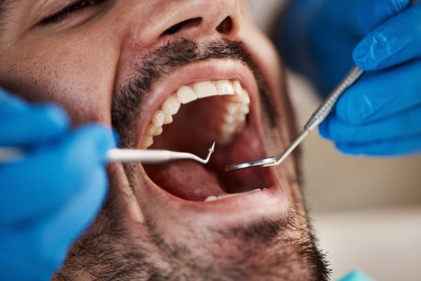 Best Emergency Wisdom Tooth Extraction in Warsaw, NC